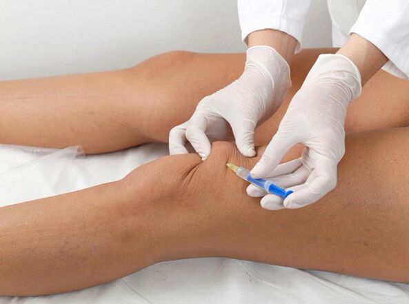 Ενδοαρθρική ένεση για οστεοαρθρίτιδα γόνατος